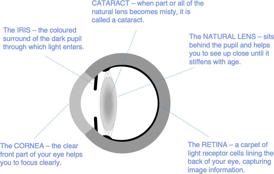 Refractive Lens Exchange Rle