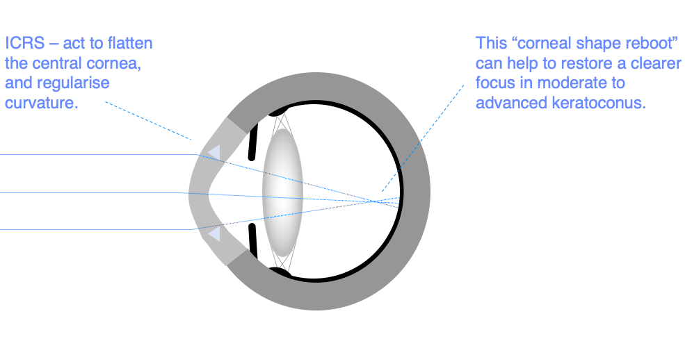 Corneal Implants Market: Top 9 Companies in the Corneal Implants Market